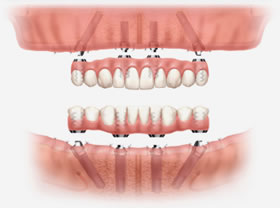 Технология ALL ON 4