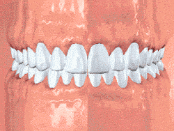 здоровая десна, гингивит, пародонтит