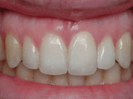 Безметалловые керамика