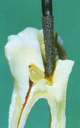 глубокая кариозная полость сообщается с полостью нерва