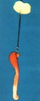 удаление воспаленного нерва