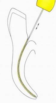 Механическая обработка корневых каналов файлами