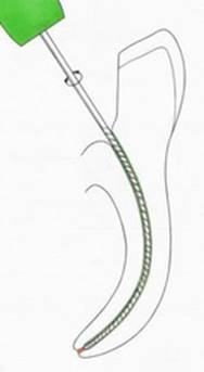 Механическая обработка корневых каналов файлами