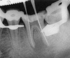 ретгеновский снимок для определения длины каналов
