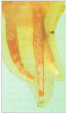 запломбированные корневые каналы