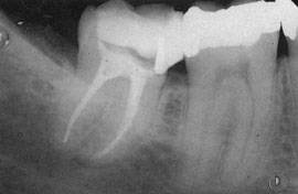 запломбированные каналы - рентген снимок