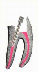 установка штифта в канал зуба