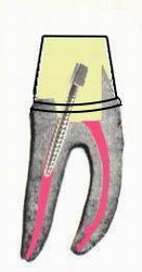 препарирование зуба под коронку