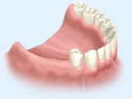 Восстановление отсутствующих зубов