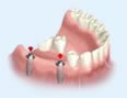 Восстановление отсутствующих зубов
